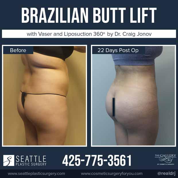 A Before and After photo of a Brazilian Butt Lift Plastic Surgery by Dr. Craig Jonov