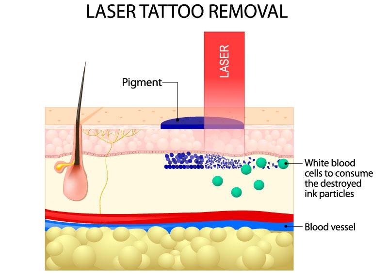 Laser Tattoo Removal  Kucumber