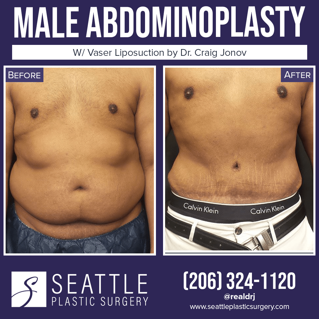 A Before and After photo of a Male Abdominoplasty Surgery With Liposuction by Dr. Craig Jonov