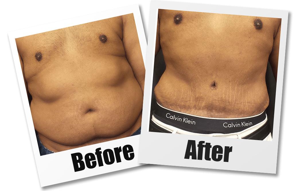 Tummy Tuck for Men Vancouver, BC