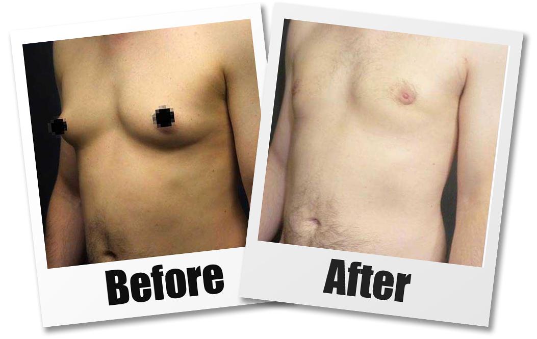 Male Breast Reduction: More Men Getting Surgery for Gynecomastia - Allure