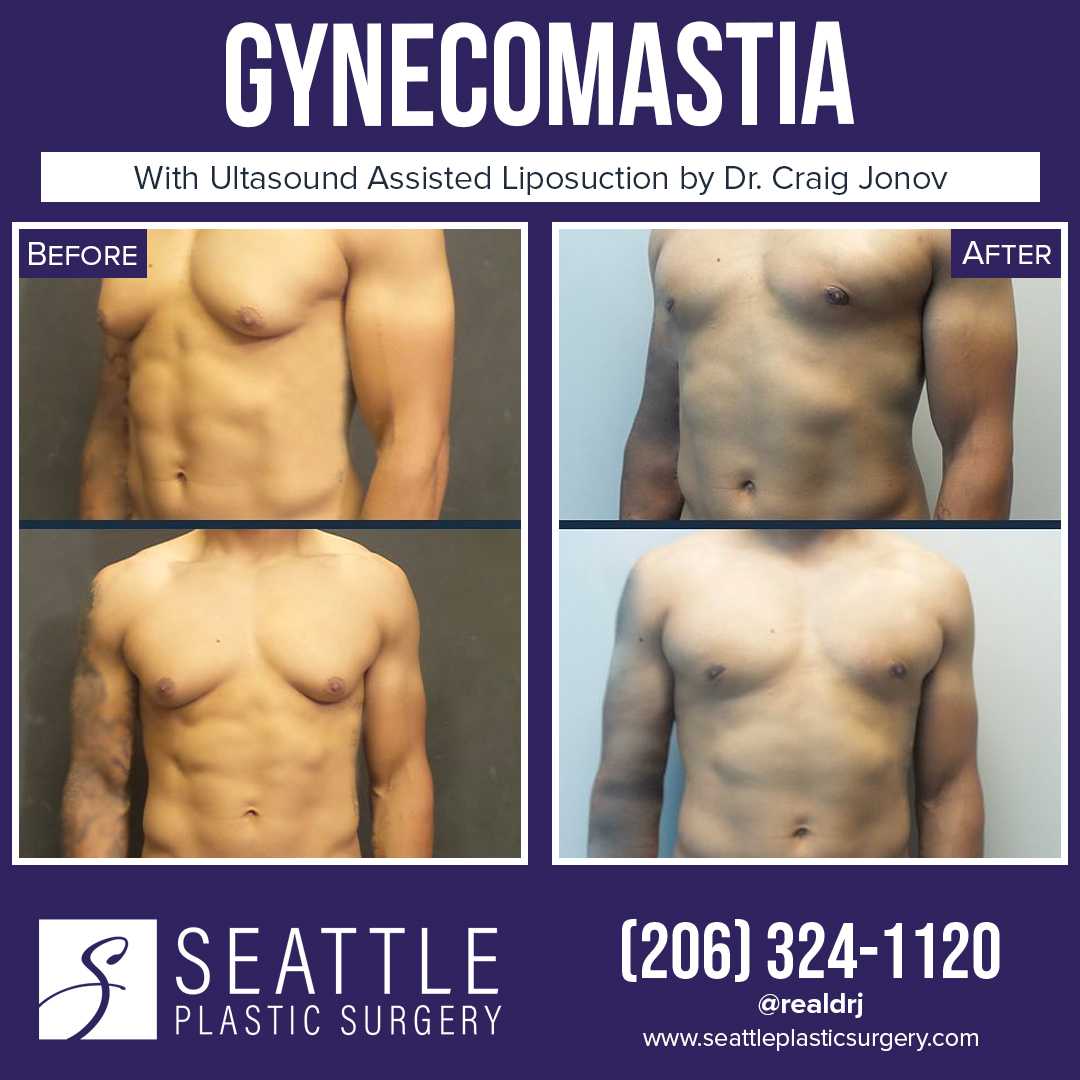 A Before and After Photo of a Plastic Surgery for Gynecomastia By Dr. Craig Jonov