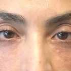 An After photo of Tear Trough filler in Seattle and Tacoma
