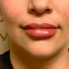 An After photo of Restylane Defyne lip filler by Injector Gyna in Seattle and Tacoma