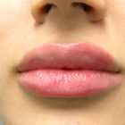 An After photo of Restylane Defyne Lip Filler in Seattle and Tacoma
