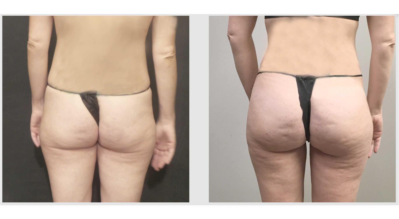 Brazilian Butt Lift (BBL) Pillow with Back Support - Snatched By Us