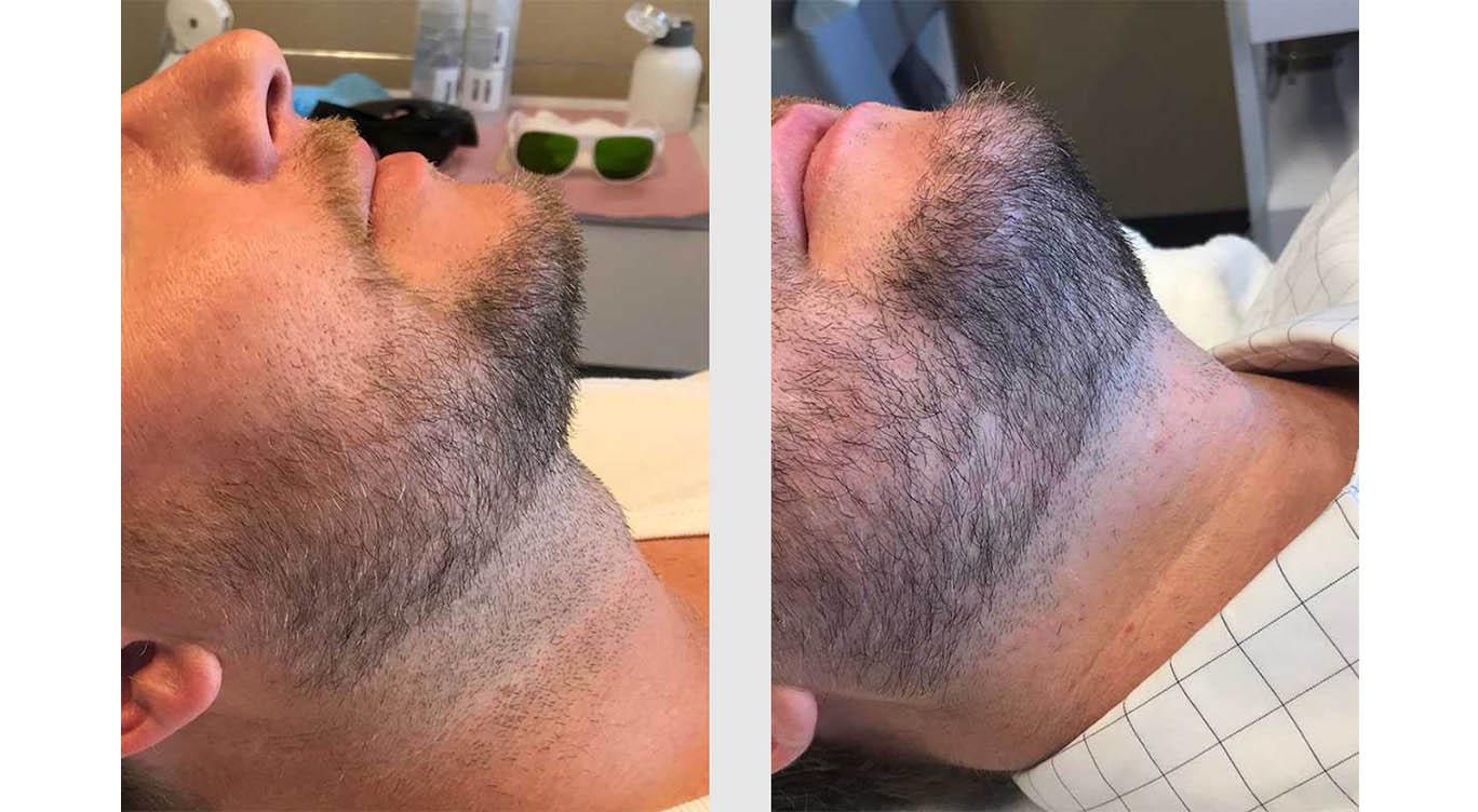 Men Permanent Face Hair Removal - Vary Beauty
