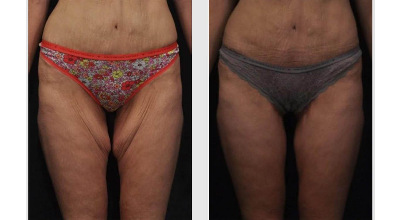 Thigh Miami - Drainless Thigh Lift - Inner Thigh Fat Removal