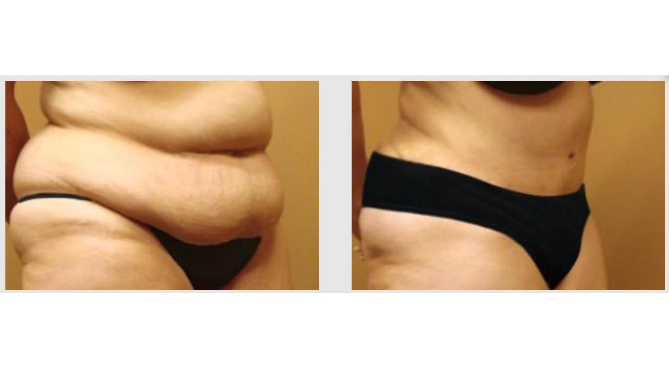 Mons Pubis Lift, Liposuction & Renuvion Skin Tightening - West End