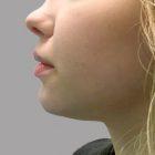 An After Photo of Chin Filler In Seattle and Tacoma