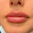 An After Photo of Restylane Kysse Lip Filler In Seattle and Tacoma