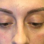 An After Photo of Under Eye Filler In Seattle and Tacoma