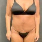 An After Photo of a Fleur-de-lis Tummy Tuck Plastic Surgery in Seattle and Tacoma