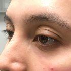 An After Photo of Under Eye Filler in Seattle and Tacoma
