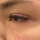 An After Photo of Under Eye Fillers in Seattle and Tacoma