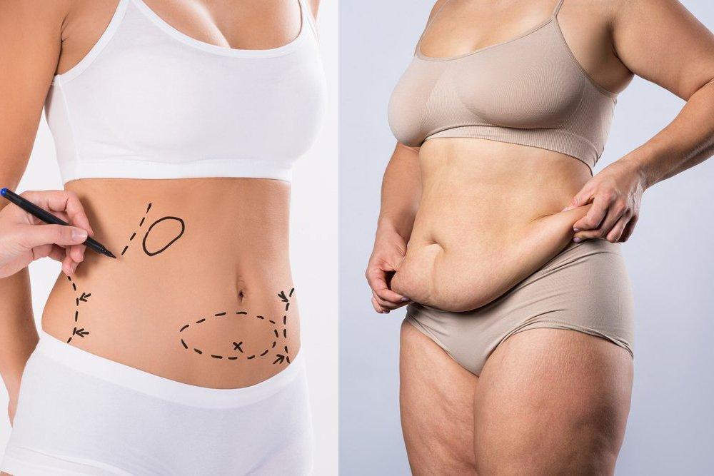 Am I a Candidate for an Extended Tummy Tuck?