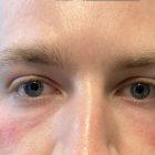 An After Photo of Under Eye Filler by Dr. K in Seattle and Tacoma