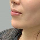 An After Photo of Chin Filler in Seattle and Tacoma