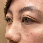 An After Photo of Tear Trough Filler in Seattle and Tacoma