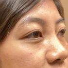 An After Photo of Tear Trough Filler in Seattle and Tacoma