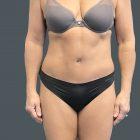 An After Photo of a Tummy Tuck Plastic Surgery by Dr. Craig Jonov in Seattle and Tacoma