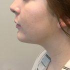 An After Photo of Chin Liposuction Plastic Surgery by Dr. Craig Jonov in Seattle and Tacoma