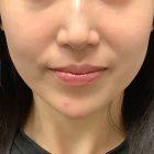 An After Photo of Cheek Filler in Seattle and Tacoma