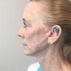An After Photo of Mini Facelift Plastic Surgery by Dr. David Santos in Seattle and Tacoma