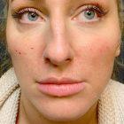 An After Photo of Cheek Filler Injections in Seattle and Tacoma