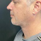 An After Photo of Chin Liposuction & Chin Augmentation Plastic Surgery by Dr. Craig Jonov in Seattle and Tacoma