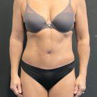 An After Photo of a Tummy Tuck Plastic Surgery by Dr. Craig Jonov in Seattle and Tacoma