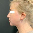 An After Photo of Chin Liposuction Plastic Surgery by Dr. Craig Jonov in Seattle and Tacoma