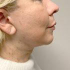 An After Photo of a Facelift & Neck Lift Plastic Surgery by Dr. David Santos in Seattle and Tacoma