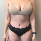 An After Photo of a Tummy Tuck Plastic Surgery by Dr. Craig Jonov in Seattle and Tacoma